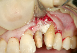 エムドゲインによる歯周再生 